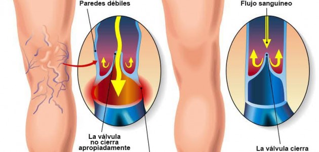 venasvaricosas