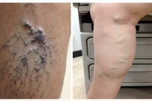 que son las varices como curarlas