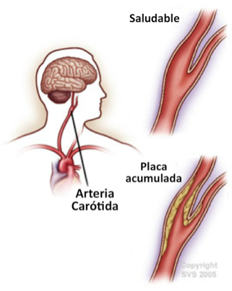 clinica de varices en caracas arteria bloqueada