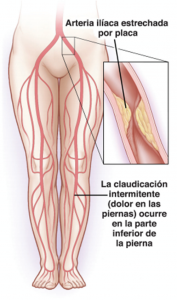 Enfermedad Arterial Periferica EAP 1