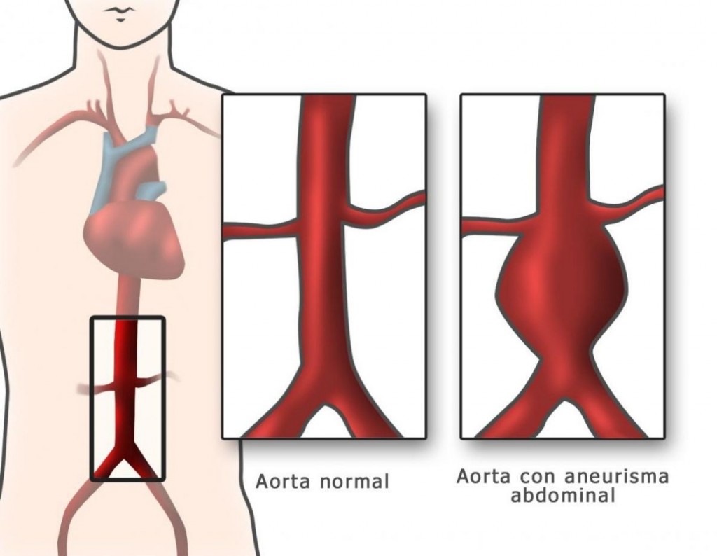 Aneurisma de Aorta Abdominal: Un Asesino Silencioso