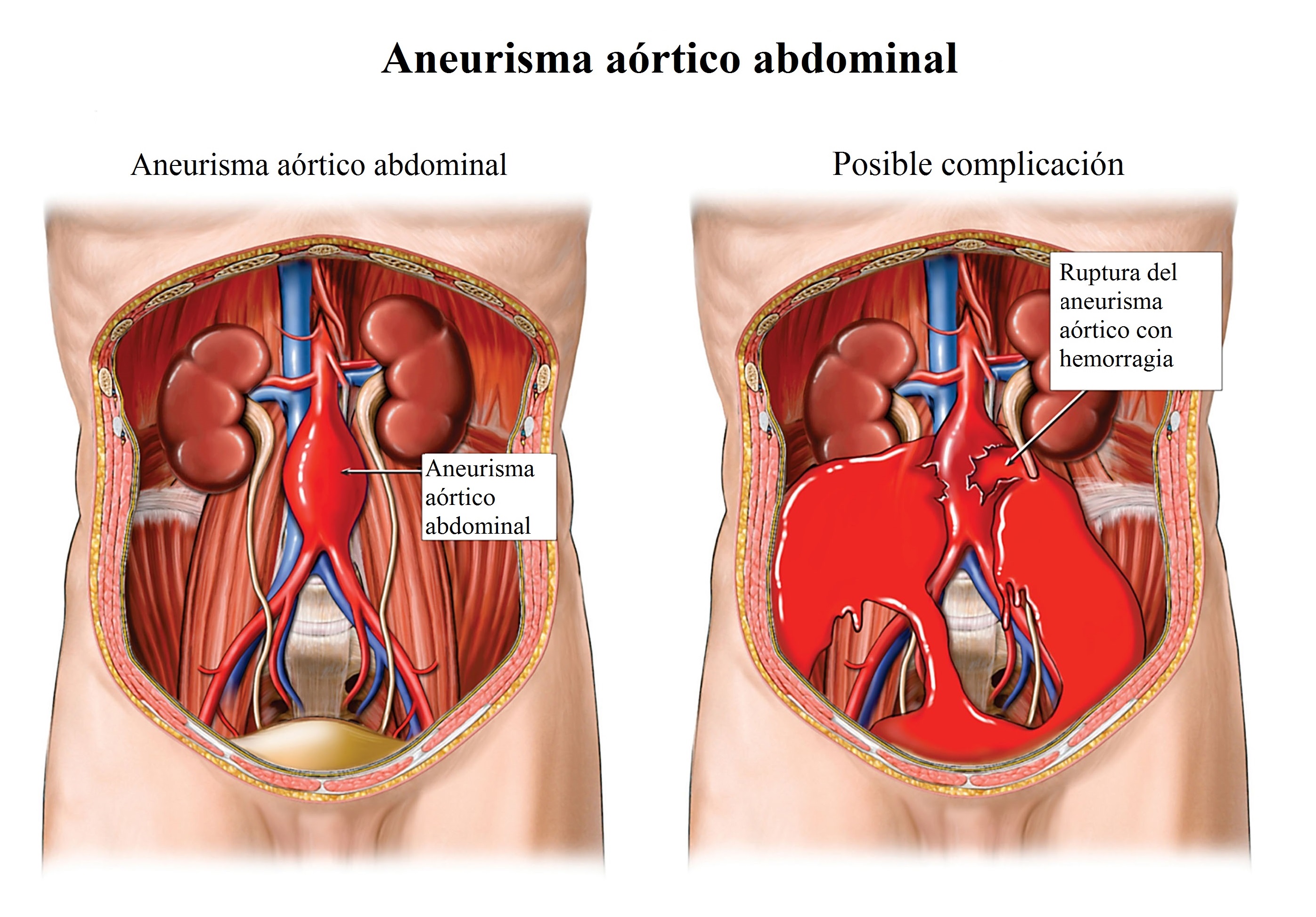 ADTTRE Abdominal Aortic Aneurysm, Rupture with Internal Hemorrhaging (Bleeding)