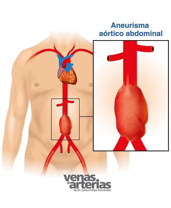 Aneurisma Aorta Abdominal