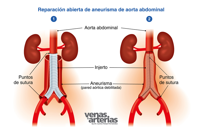 Aneurisma de Aorta Abdominal