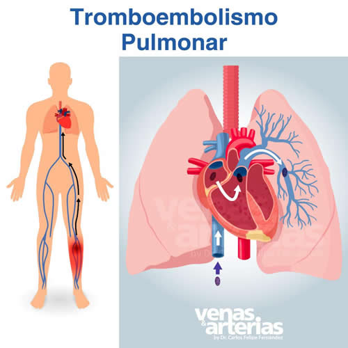 Tromboembolismo Pulmonar