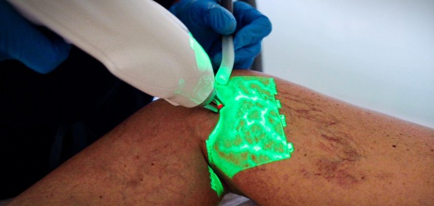 tratamiento sin agujas varices caracas